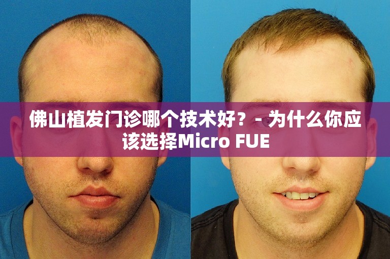 佛山植发门诊哪个技术好？- 为什么你应该选择Micro FUE