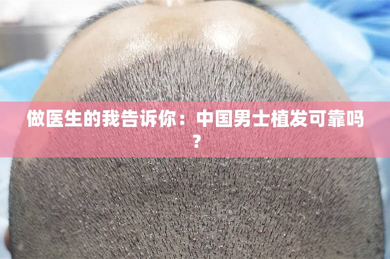 做医生的我告诉你：中国男士植发可靠吗？