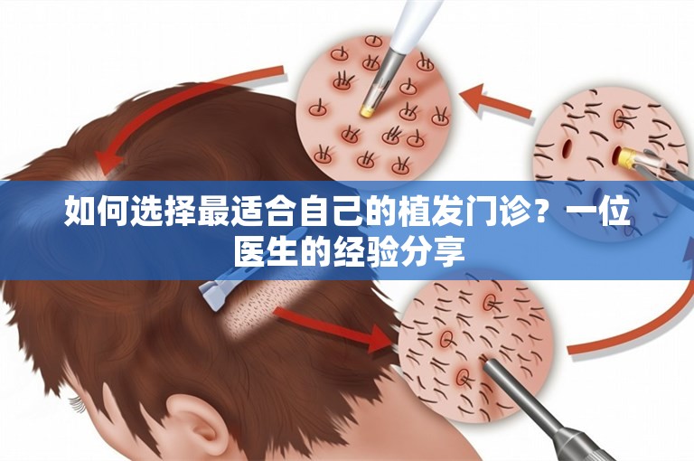 如何选择最适合自己的植发门诊？一位医生的经验分享