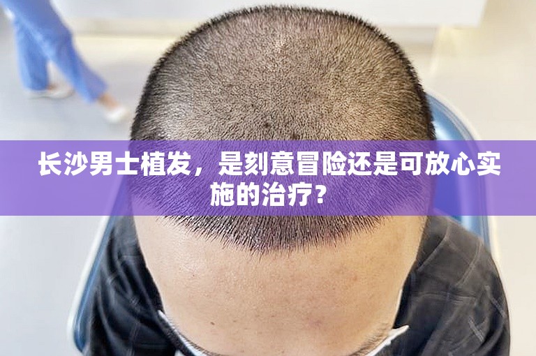 长沙男士植发，是刻意冒险还是可放心实施的治疗？