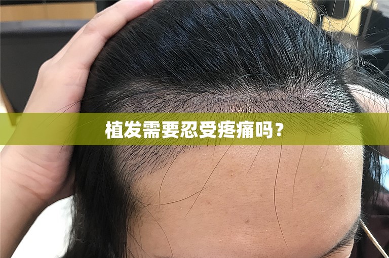 植发需要忍受疼痛吗？