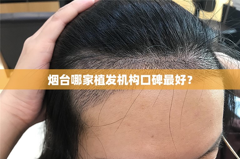 烟台哪家植发机构口碑最好？