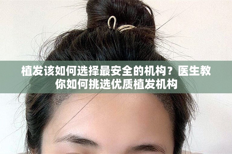 植发该如何选择最安全的机构？医生教你如何挑选优质植发机构