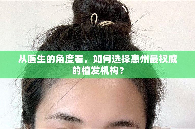 从医生的角度看，如何选择惠州最权威的植发机构？