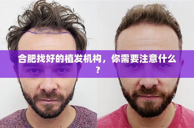 合肥找好的植发机构，你需要注意什么？