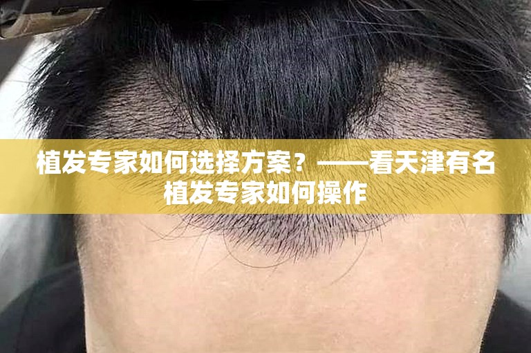 植发专家如何选择方案？——看天津有名植发专家如何操作