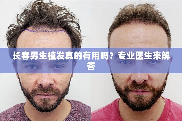 长春男生植发真的有用吗？专业医生来解答