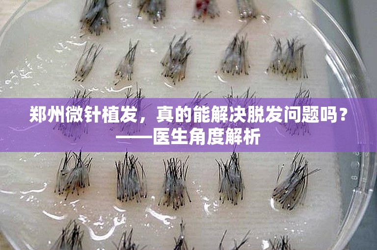 郑州微针植发，真的能解决脱发问题吗？——医生角度解析