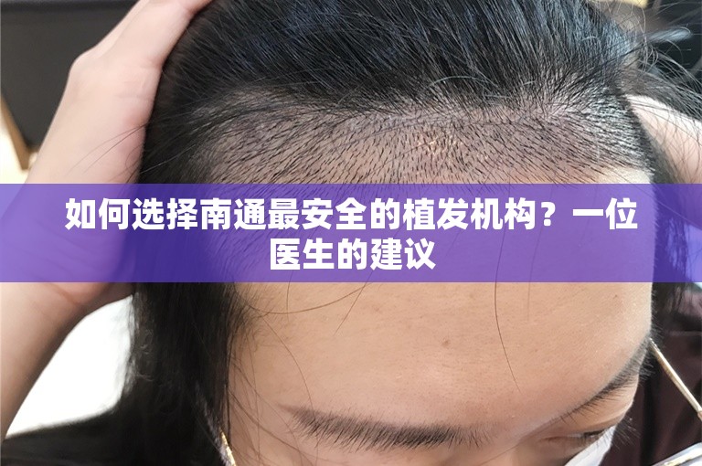 如何选择南通最安全的植发机构？一位医生的建议