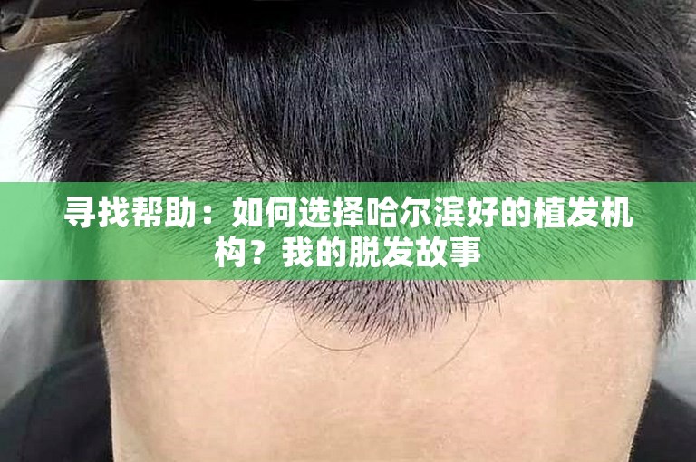 寻找帮助：如何选择哈尔滨好的植发机构？我的脱发故事