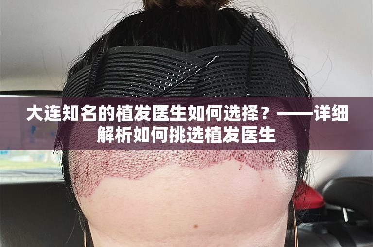 大连知名的植发医生如何选择？——详细解析如何挑选植发医生