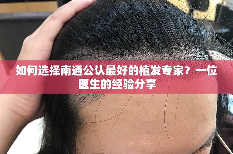 如何选择南通公认最好的植发专家？一位医生的经验分享