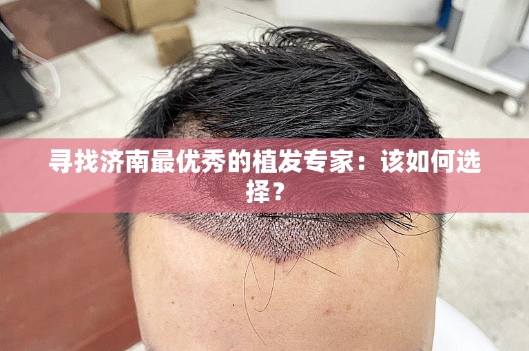 寻找济南最优秀的植发专家：该如何选择？