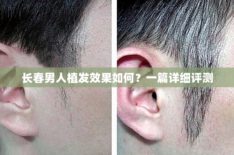 长春男人植发效果如何？一篇详细评测