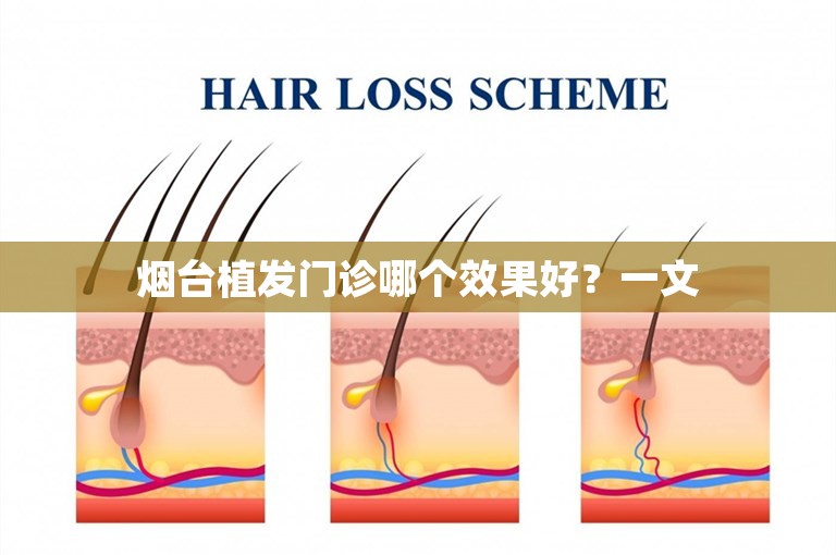 烟台植发门诊哪个效果好？一文