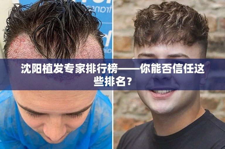 沈阳植发专家排行榜——你能否信任这些排名？