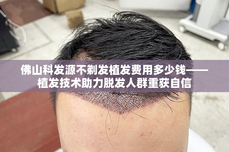 佛山科发源不剃发植发费用多少钱——植发技术助力脱发人群重获自信