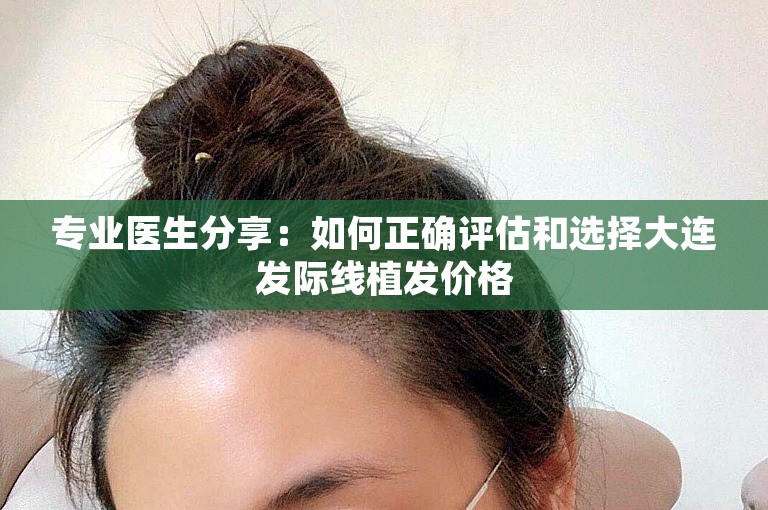 专业医生分享：如何正确评估和选择大连发际线植发价格