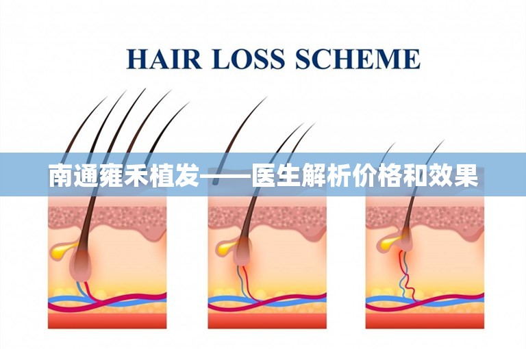 南通雍禾植发——医生解析价格和效果