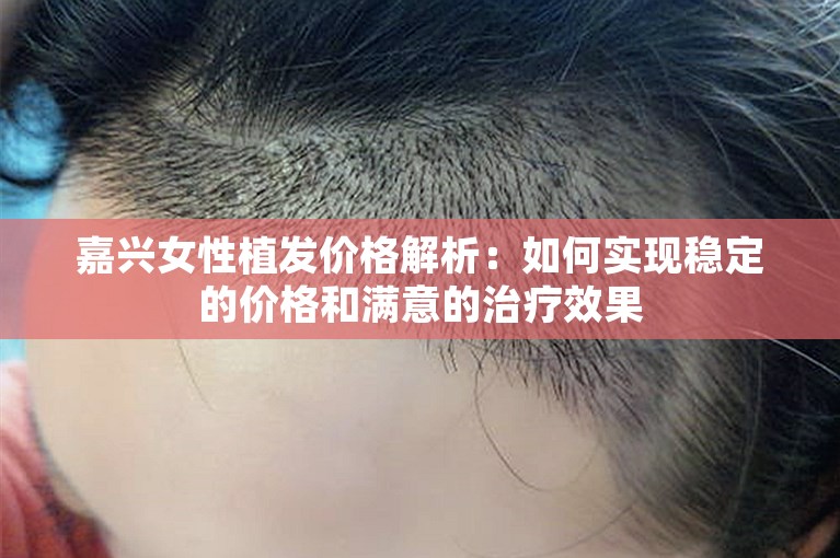 嘉兴女性植发价格解析：如何实现稳定的价格和满意的治疗效果