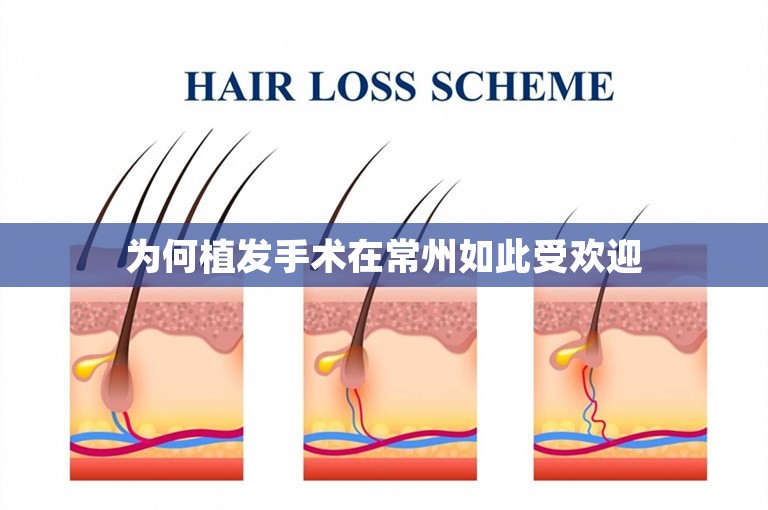 为何植发手术在常州如此受欢迎