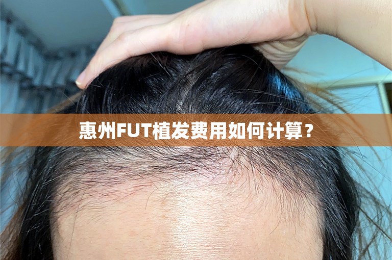 惠州FUT植发费用如何计算？