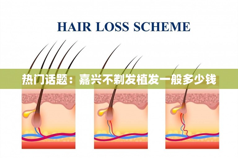 热门话题：嘉兴不剃发植发一般多少钱