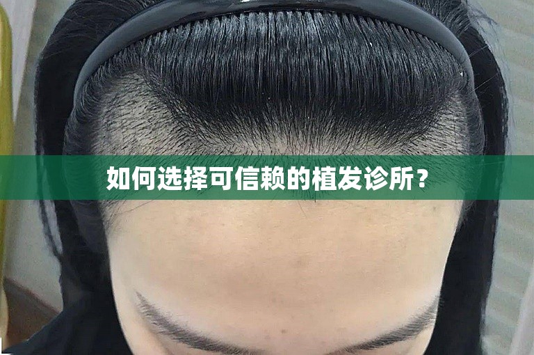 如何选择可信赖的植发诊所？