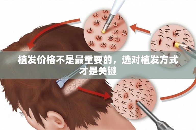 植发价格不是最重要的，选对植发方式才是关键