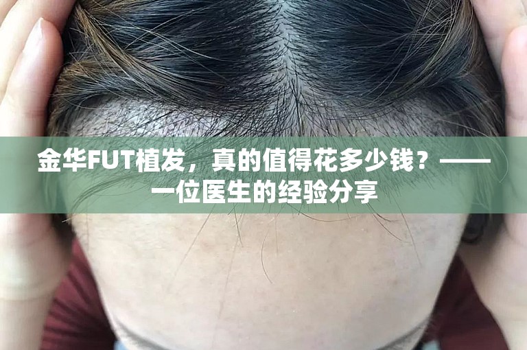 金华FUT植发，真的值得花多少钱？——一位医生的经验分享