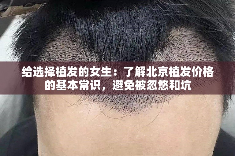 给选择植发的女生：了解北京植发价格的基本常识，避免被忽悠和坑