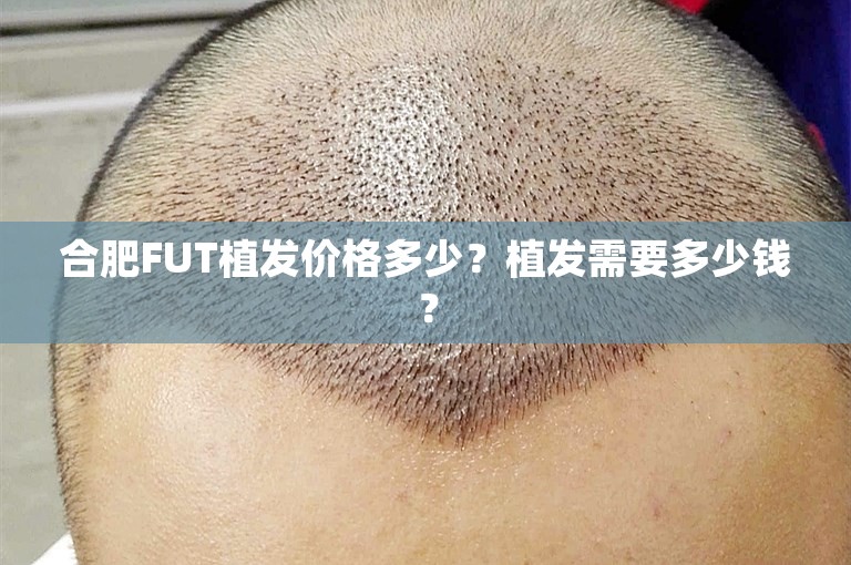 合肥FUT植发价格多少？植发需要多少钱？