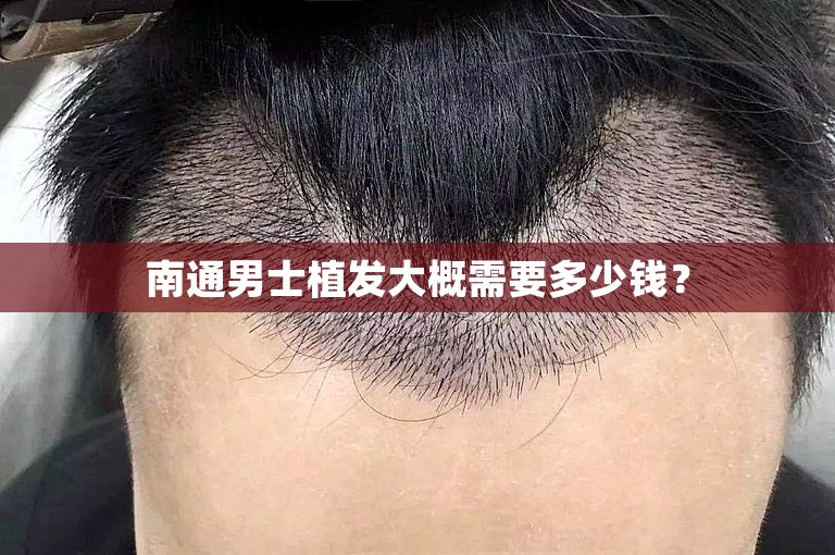 南通男士植发大概需要多少钱？