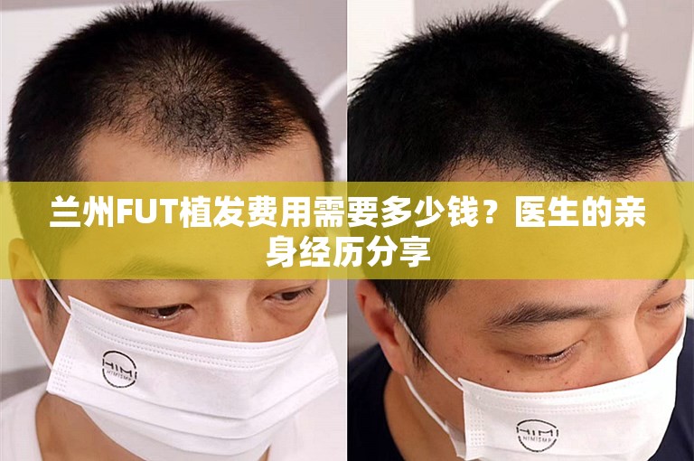 兰州FUT植发费用需要多少钱？医生的亲身经历分享