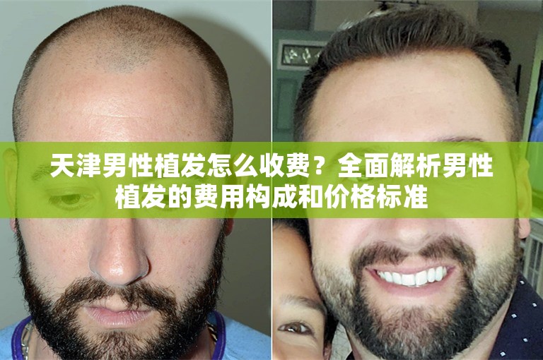 天津男性植发怎么收费？全面解析男性植发的费用构成和价格标准