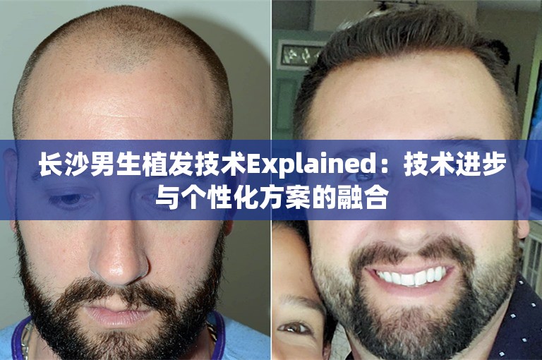 长沙男生植发技术Explained：技术进步与个性化方案的融合