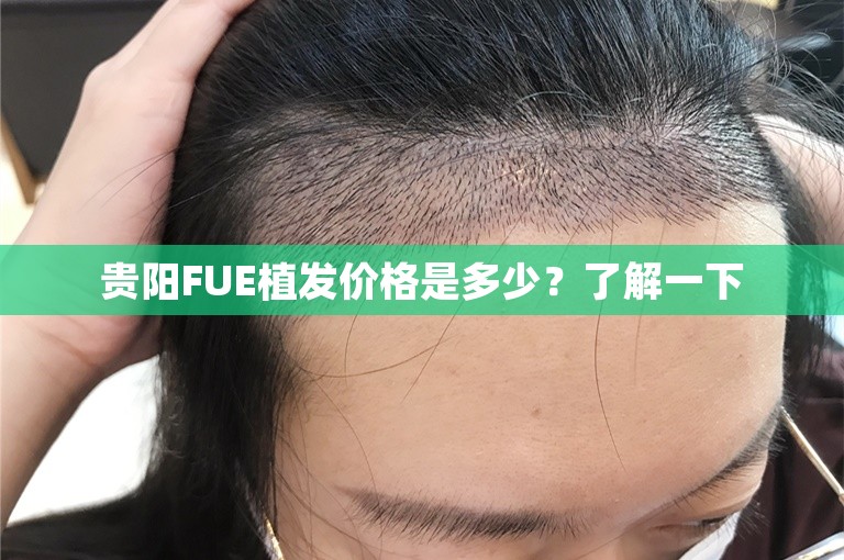 贵阳FUE植发价格是多少？了解一下