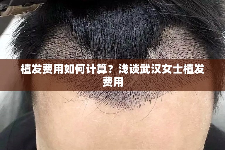 植发费用如何计算？浅谈武汉女士植发费用