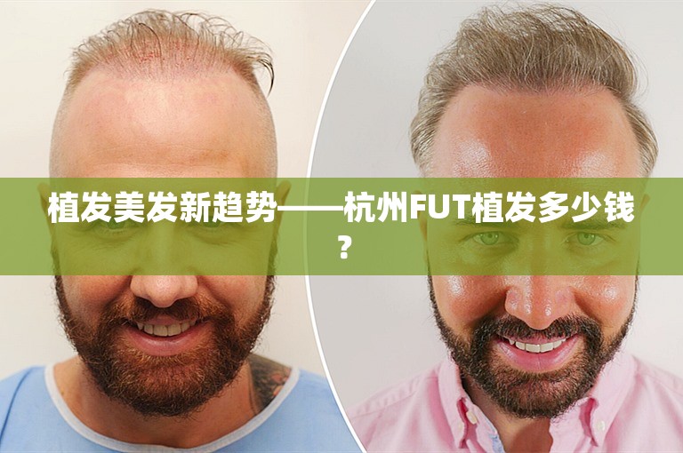 植发美发新趋势——杭州FUT植发多少钱？