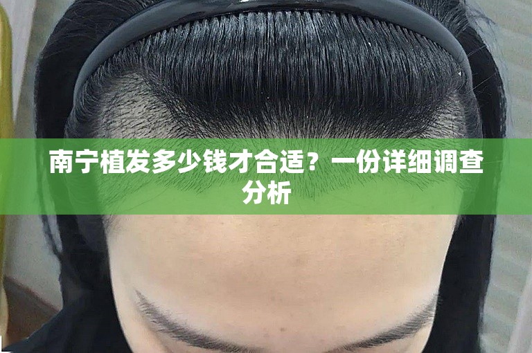 南宁植发多少钱才合适？一份详细调查分析