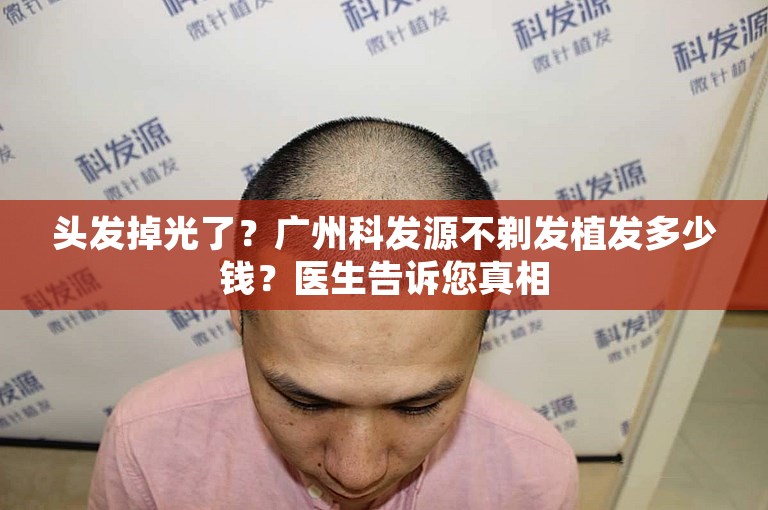 头发掉光了？广州科发源不剃发植发多少钱？医生告诉您真相