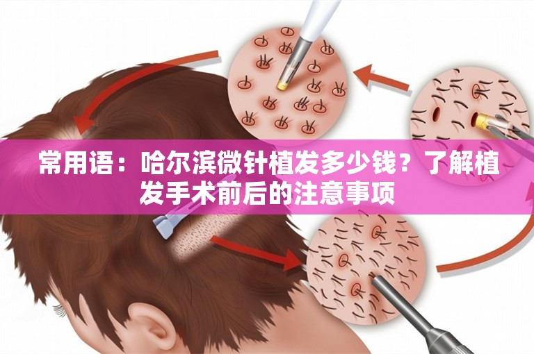 常用语：哈尔滨微针植发多少钱？了解植发手术前后的注意事项