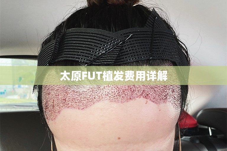 太原FUT植发费用详解