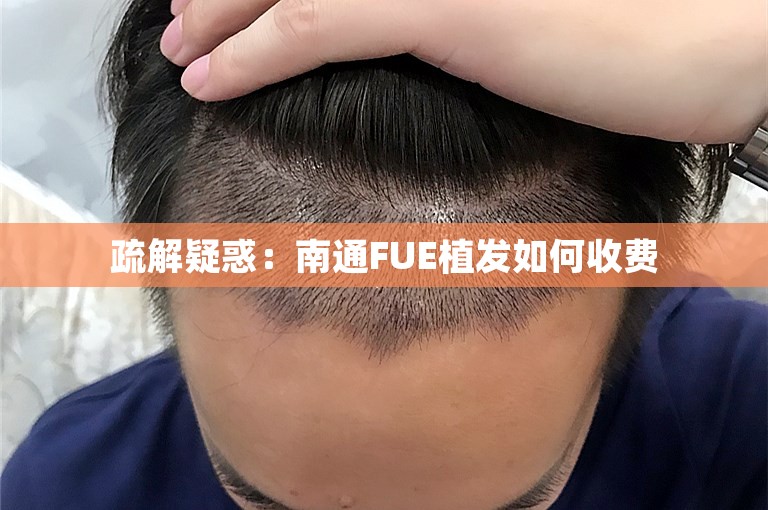 疏解疑惑：南通FUE植发如何收费