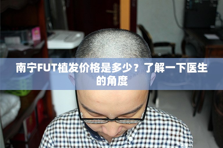 南宁FUT植发价格是多少？了解一下医生的角度