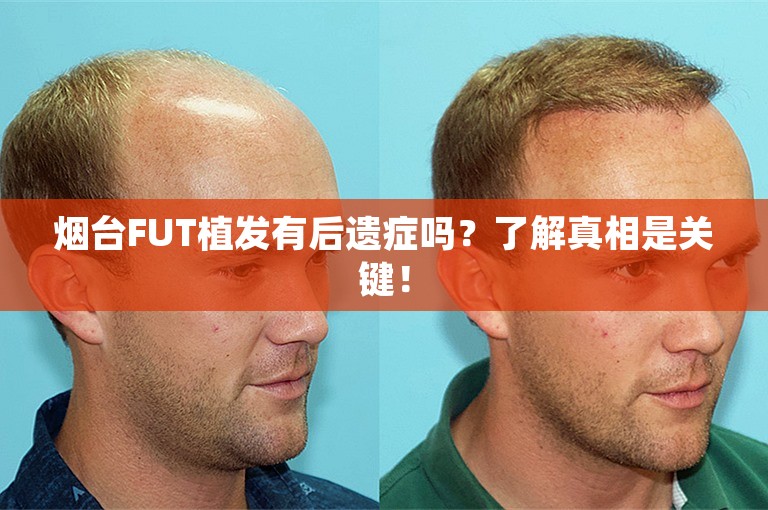 烟台FUT植发有后遗症吗？了解真相是关键！