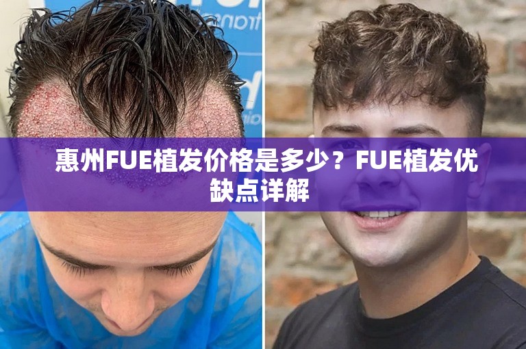  惠州FUE植发价格是多少？FUE植发优缺点详解 