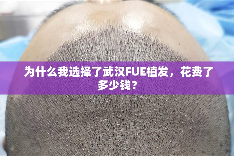  为什么我选择了武汉FUE植发，花费了多少钱？