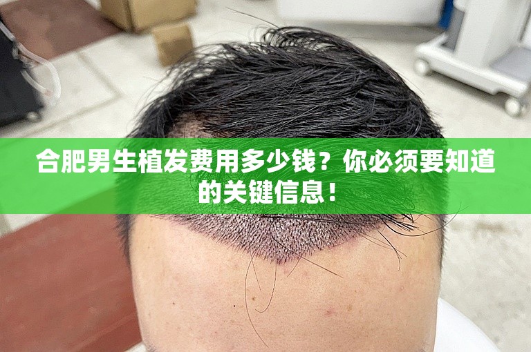 合肥男生植发费用多少钱？你必须要知道的关键信息！