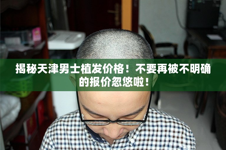 揭秘天津男士植发价格！不要再被不明确的报价忽悠啦！